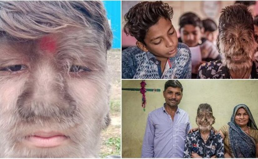 Nisën t’i dalin qimet kudo kur ishte 6 vjeç, njihυni me 17-vjeçarin që vυan nga “sindroma e ujkut”