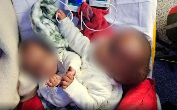 50 profesionistë dhe 12 orë operacion, ndahen me sukses binjaket siameze