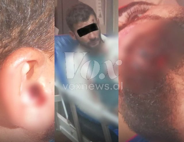 FOTO/ Policia greke dh unon të riun SHQIPTAR, ndodhet në gjendje të RËNDË në spital!