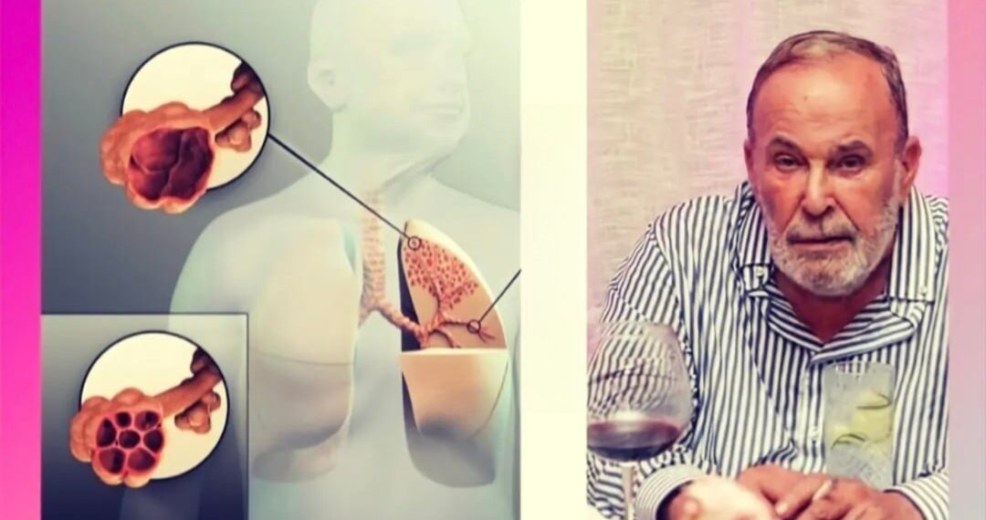 Nga se shkaktohet dhe çfarë është ‘SPOK’, sëmundja e pashërueshme që i mori jetën Fatos Nanos